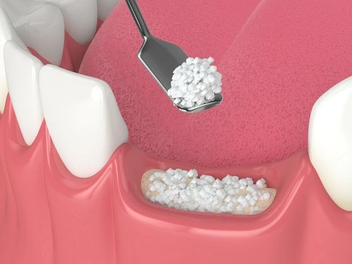 How to Speed Up Bone Graft Healing process
